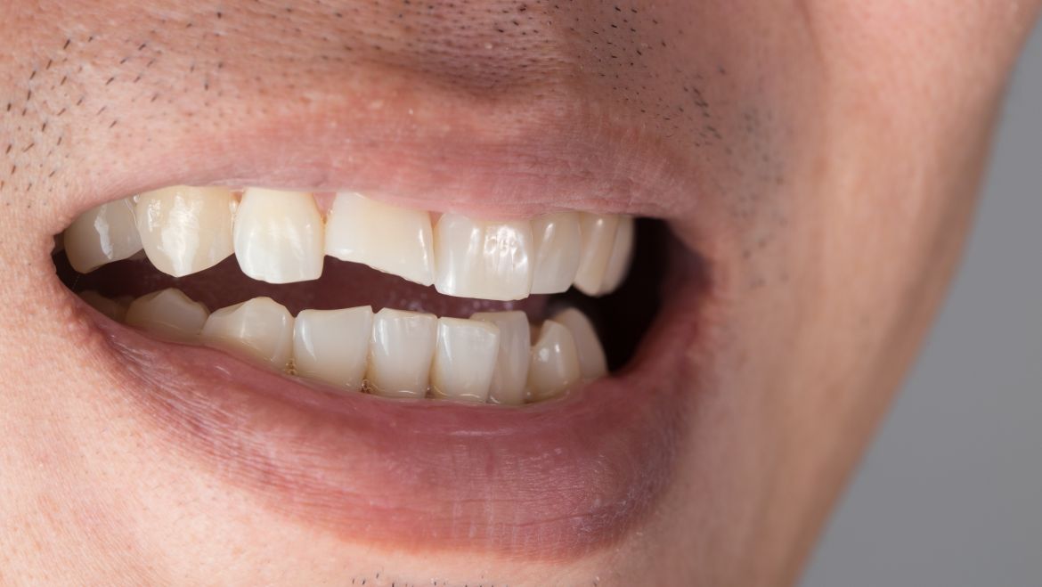 Traumatismos dentales. Urgencia odontológica
