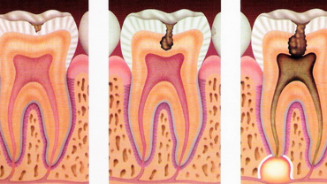 Qué son las caries y cómo afectan a nuestros dientes