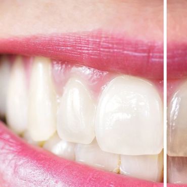 Tipos de blanqueamiento dental