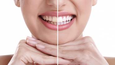 Blanqueamiento Dental en La Palma del Condado