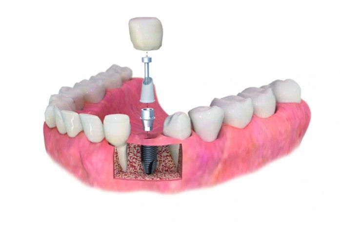 implantes-clinica-dental-barra-soto.jpg