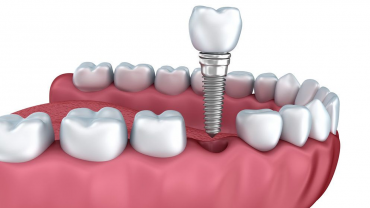 Todo sobre los implantes dentales