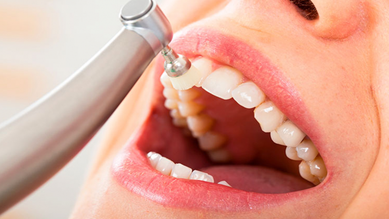 Limpieza dental profesional