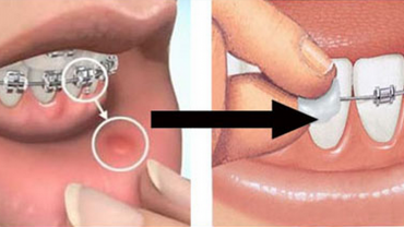 Molestias con brackets